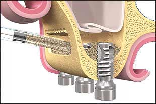 Elevación del seno maxilar para implantes dentales