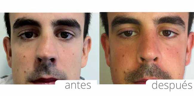 Rinoplastia tabique desviado antes y despues de adelgazar