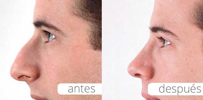 Rinoplastia Hombre Fotos Antes Y Despues