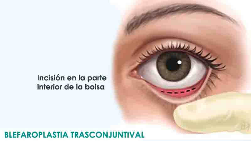 Cirugía de párpados inferiores mediante blefaroplastia transconjuntival en Madrid