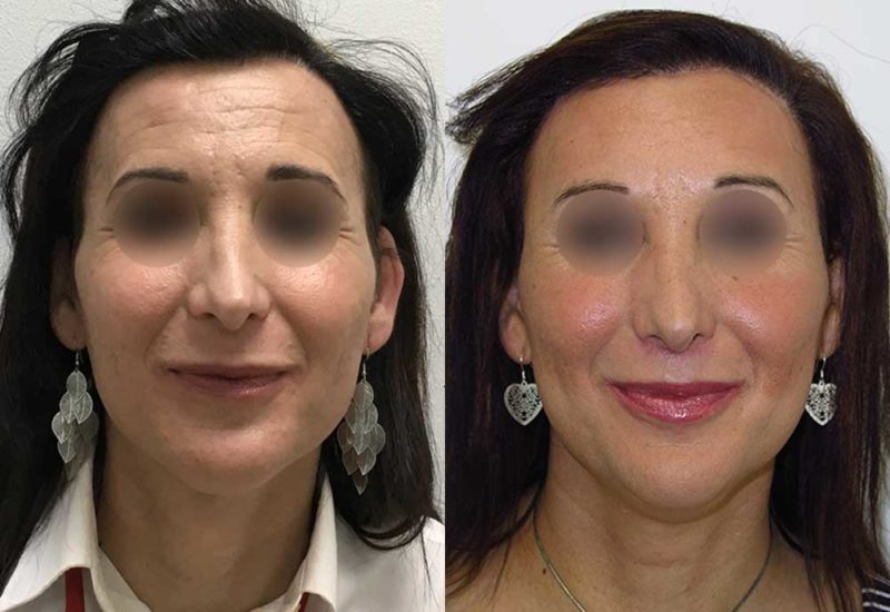 Cirugía de feminización facial de Lola