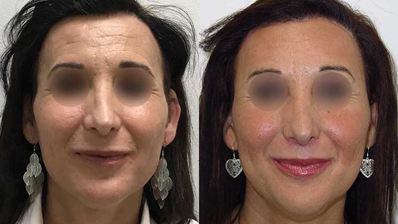 Cirugía feminización facial tránsgenero