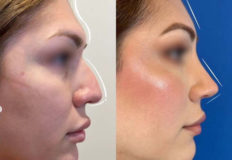 Feminización facial de nariz y frente perfil