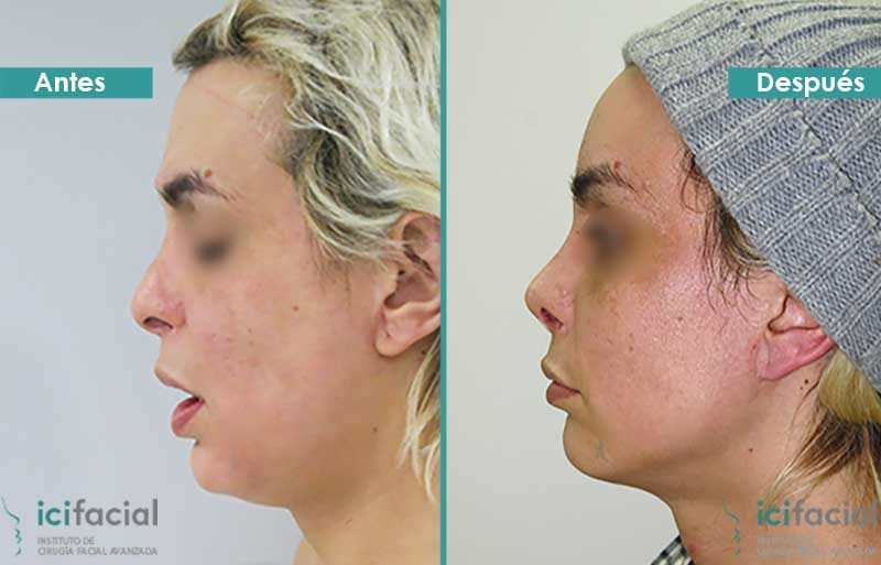 Paciente operada de feminización facial: frontoplastia (frente), rinoplastia de feminización y elevación de cejas