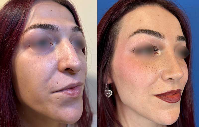 Feminización facial y frontoplastia