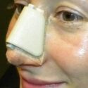 Las férulas nasales post rinoplastia son dispositivos de plástico o silicona que se utilizan para estabilizar la nariz después de la cirugía de nariz.