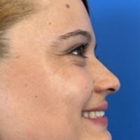 Fotografía de perfil derecho sonriendo para valoración de rinpolastia por el Doctor Macía