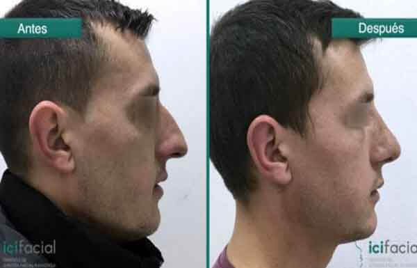 Hombre sometido limado de caballete en nariz aguileña en Madrid