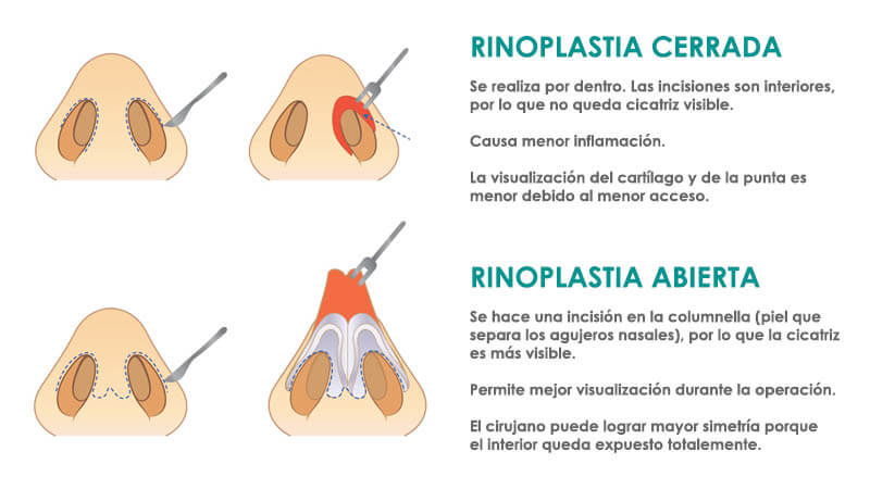 Rinoplastia abierta y cerrada