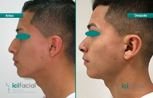 Paciente de rinoplastia sometido a una operación de nariz en Icifacial