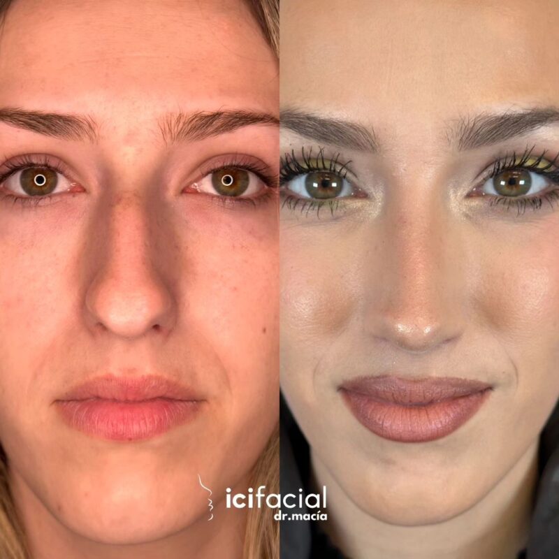 Rinoplastia en Madrid de chica joven por el Dr Macia de Icifacial