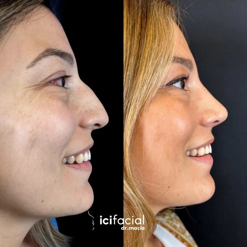 Rinoplastia en Madrid de chica joven por el Dr Macia de Icifacial