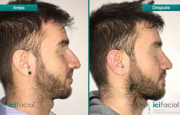Rinoplastia en Madrid de nariz aguileña en hombre por Dr Macía