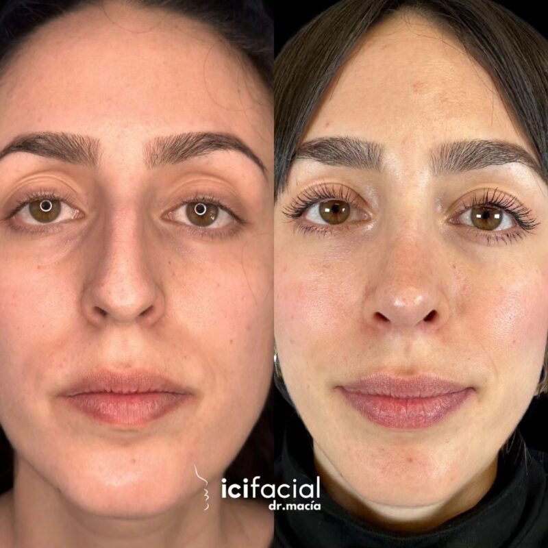 Rinoplastia en Madrid de chica joven por el Dr Macia de Icifacial