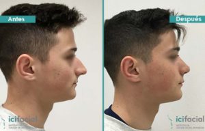Rinoplastia ultrasónica reducción de punta de nariz