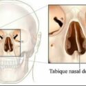 Corregir tabique desviado con rinoplastia en Icifacial