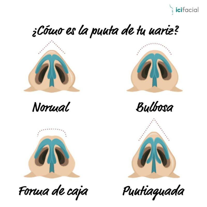 Tipos de punta nasal en rinoplastia